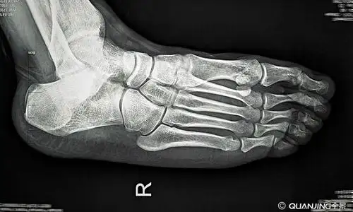 医学x光片脚掌骨骼