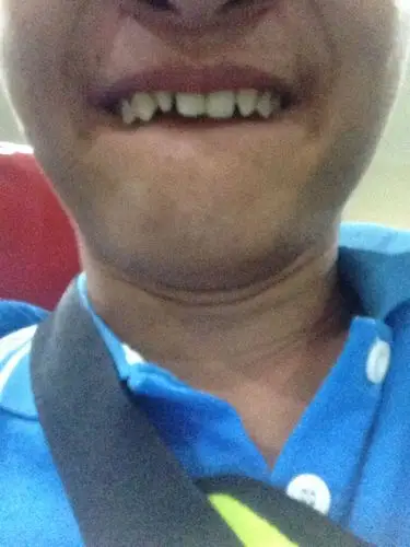 我的牙齿很尖.而且门牙隔壁两颗牙还有牙缝.能用什么手法矫正吗?