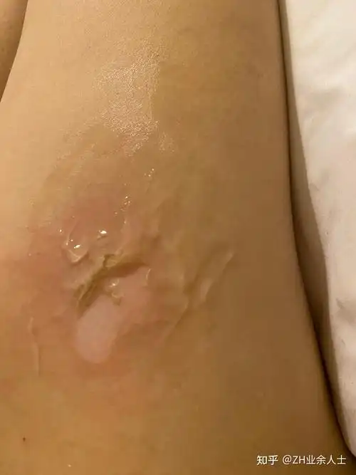 被卷发棒烫伤烫破皮会留疤吗?怎么恢复呢