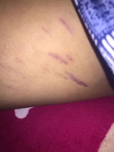 大腿内侧突然出现这些划痕.发紫.摸上去是凹进去的.也不疼不痒