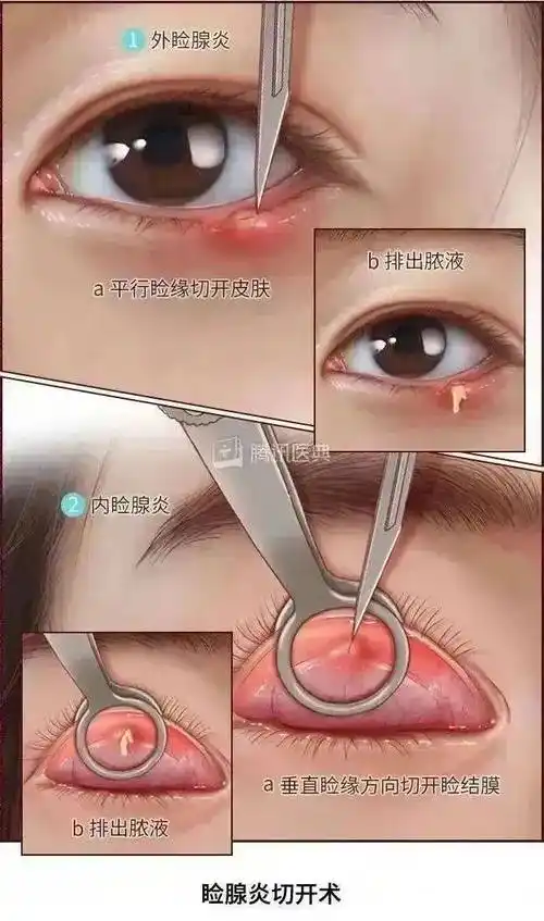 长了麦粒肿怎样才能消得快