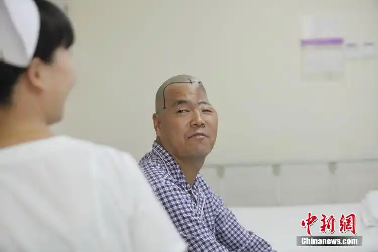 男子高空坠落成了"半头人" 3d打印修复脑盖