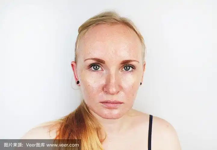 油性和问题皮肤.一个金发女孩的肖像痤疮,油性皮肤和色素沉着