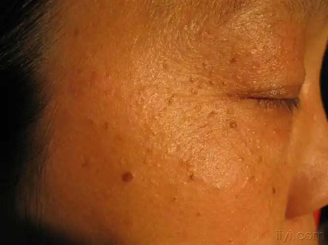 看图识病----------粟丘疹 - 皮肤及性传播疾病讨论版 - 爱爱医医学