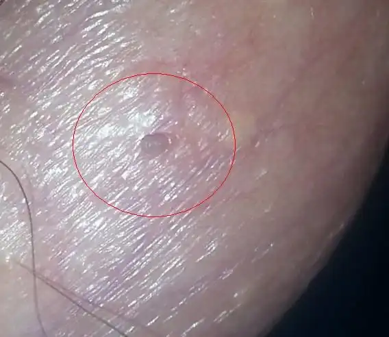 阴囊上起了个小肉阄,脖子上,腋下,乳头边上个有一