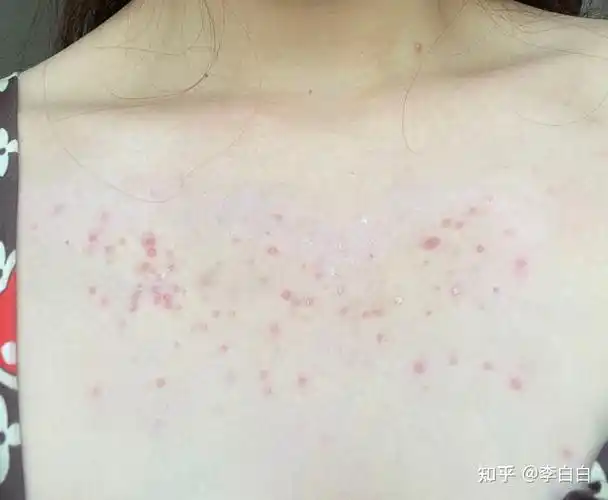 胸前突然长一大片小小的痘痘