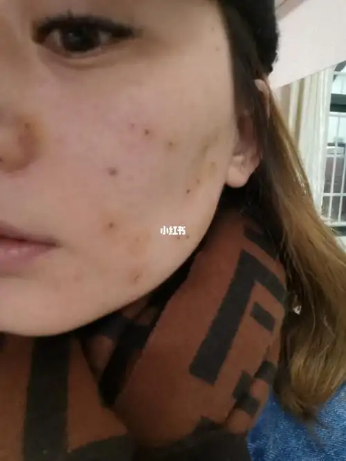 激光去扁平疣记录