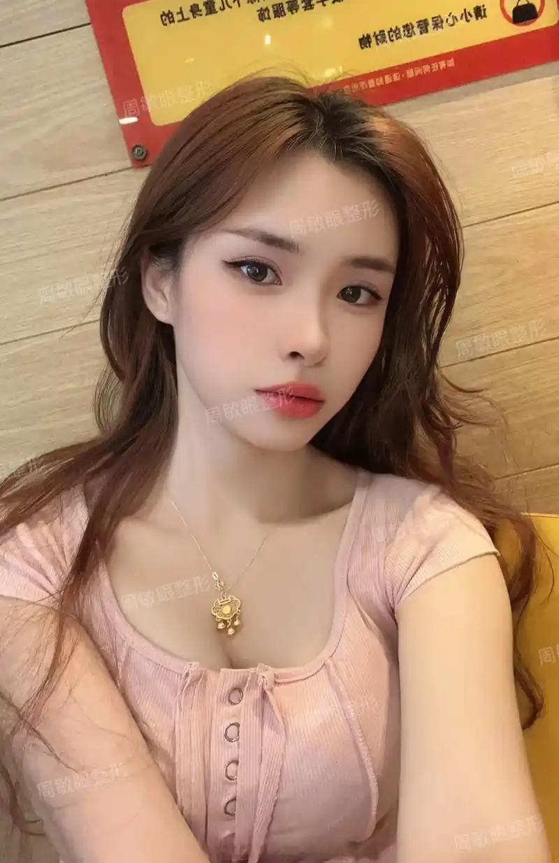 平扇型双眼皮案例,术后3个月反馈~#周敏双眼皮##切开重睑术