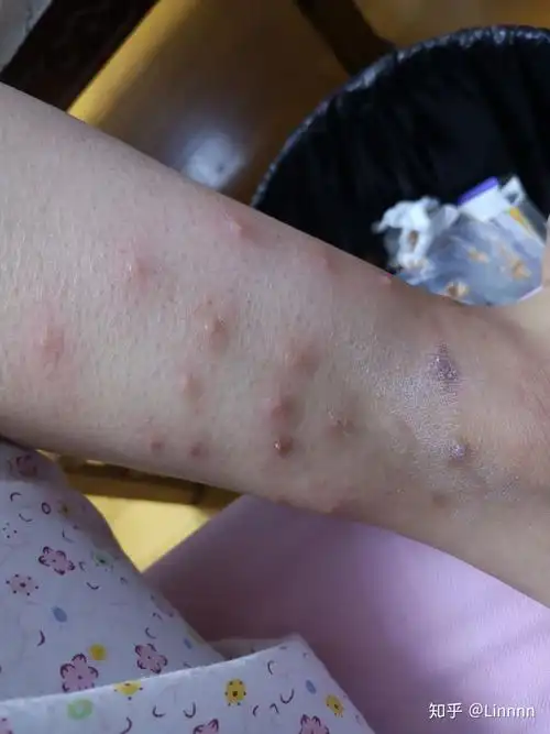 被跳蚤咬的全身都是包是什么样的感受