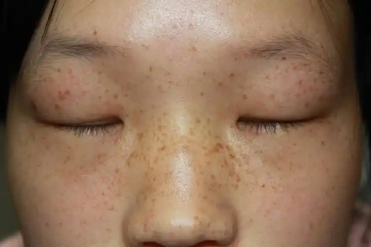 脸上雀斑有损颜值皮肤科专家帮你搞定新年面子问题