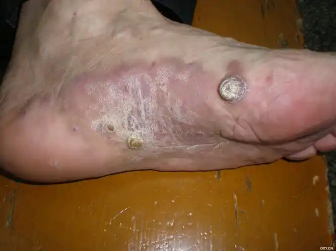 【共享】经典型kaposi肉瘤