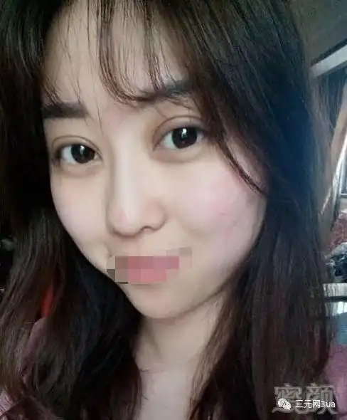 8mm平行双眼皮恢复日记