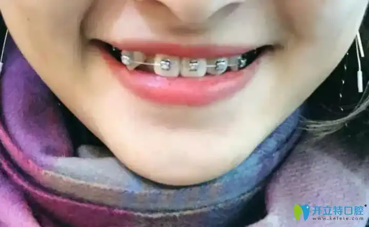 在济南品洁口腔矫正虎牙83天晒我的虎牙戴牙套变化图