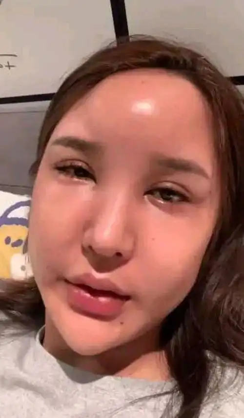 网红"桃花宝宝"整容后遗症:脸像"天鹅头",嘴变"大香肠"