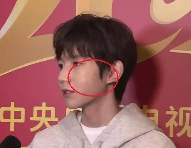 原创王源再次接受电视采访在照妖镜之下面部上痘痘很明显