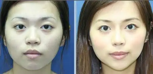 > 玻尿酸注射前后对比效果(图)(2)