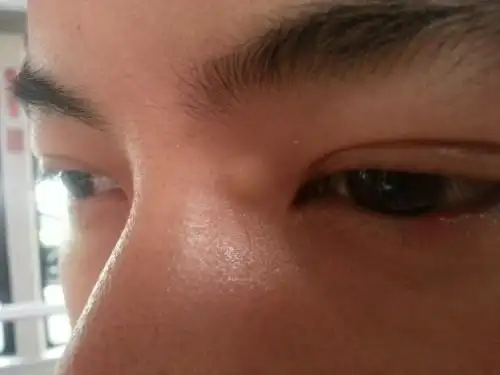 眼睛旁边长了个小肿块,有图请大家看下是什么,该去医院哪个科室看.