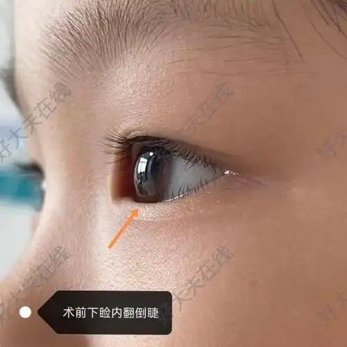 先天性睑内翻伴倒睫