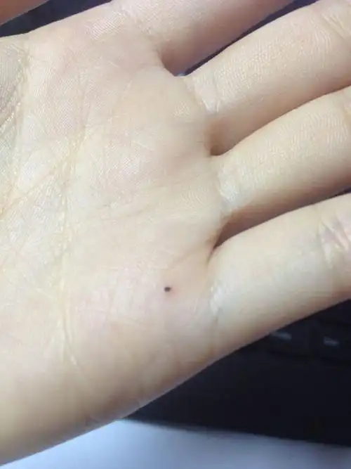 手掌上长了个小黑痣,有点突起,按着才有点痛,哪位知道这是什么?