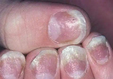 顶针状指甲上出现凹坑以点状形式分布在指甲整个表面上的凹痕是银屑病