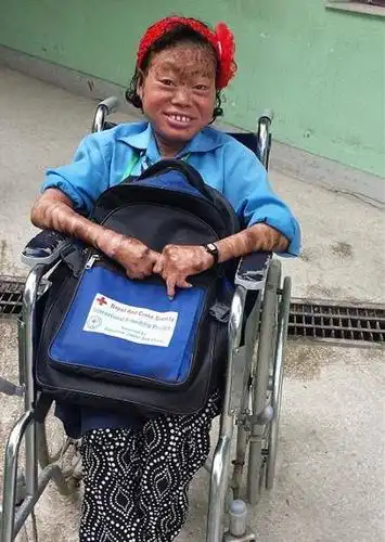 鱼鳞病:让一位13岁小姑娘看起来如同60岁老人!