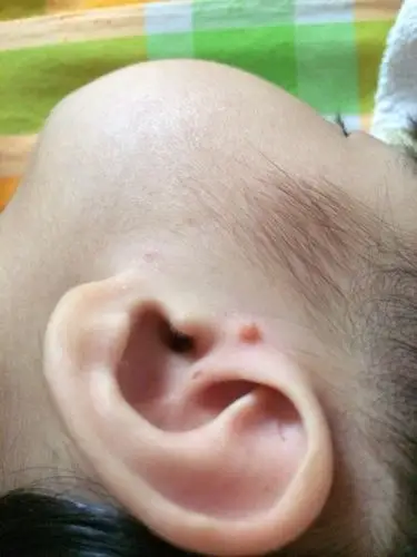 耳垂上和耳朵后面总是长疙瘩,摸的话会疼,过一段会下去,但总是.