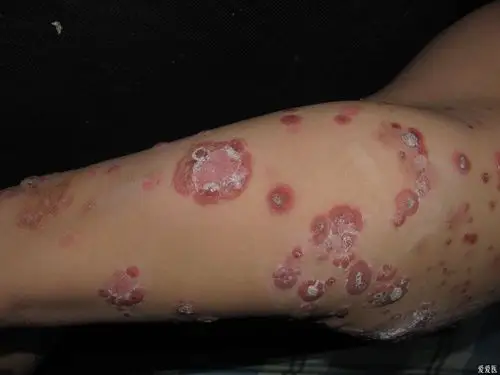 4) - 皮肤及性传播疾病讨论版 - 爱爱医医学论坛