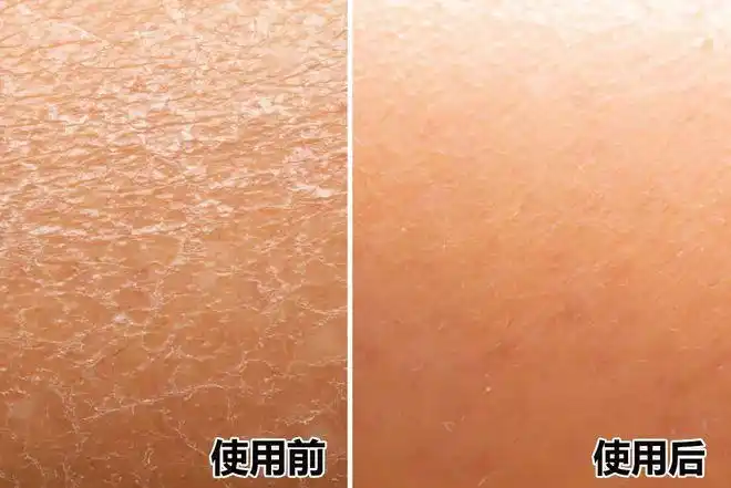 皮肤干痒泛红手脚皴裂涂它皮肤滋润更舒服