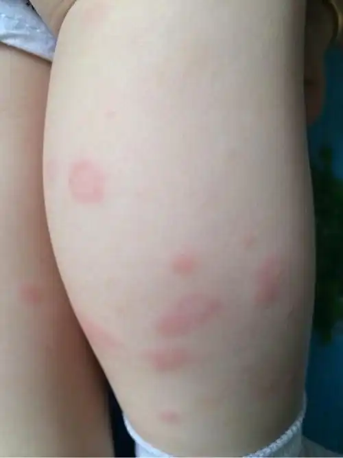 科普知识:孩子荨麻疹