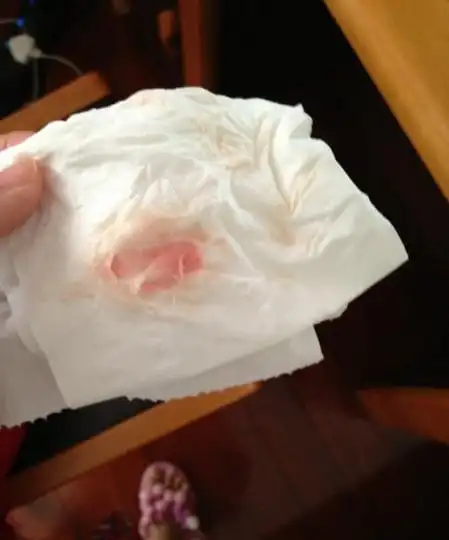 孕早期出血的孕妇有很多,据统计,至少有20%的孕妈妈在怀孕初期有过