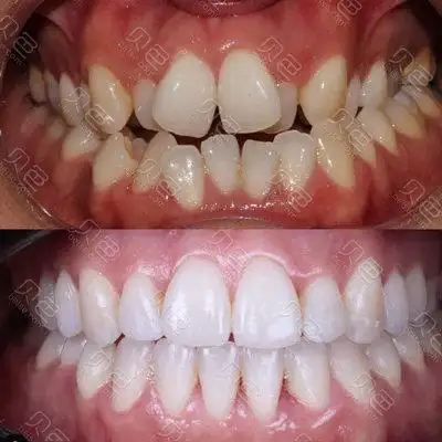牙齿矫正前后对比