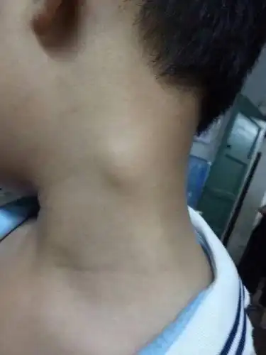 有一个东西在脖子上那是什么?需要动手术吗?