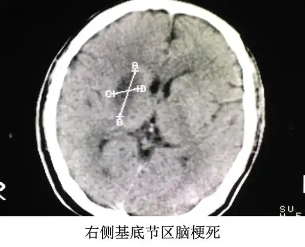 读懂头颅ct并不难教你成为读片小能手