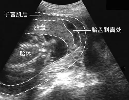 一例胎盘早剥的生死抢救
