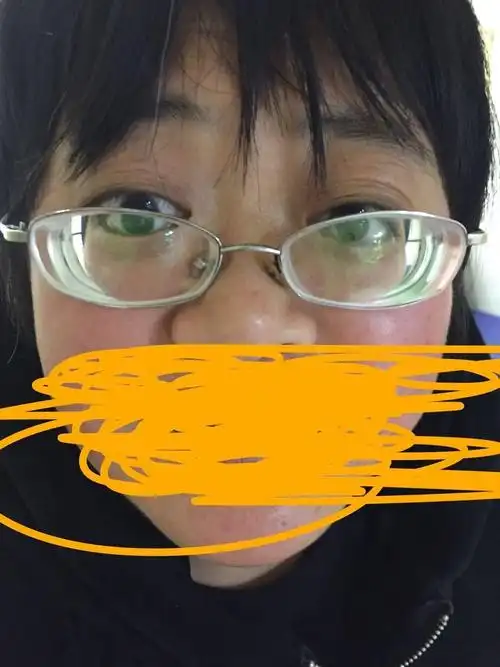 高度近视真的跟遗传有关吗图