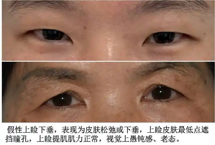 上睑下垂的诊断,治疗和护理_上睑下垂_发病原因_检查_治疗方式_日常注