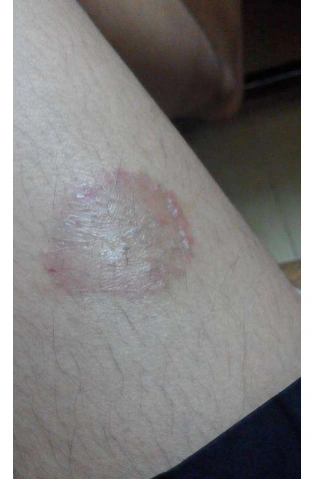 体股癣初期现象图片8