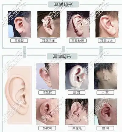 耳畸形常见的十种类型