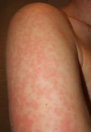 卵巢畸会引发皮肤瘙痒吗