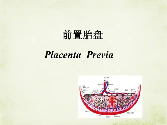 凶险性前置胎盘伴胎盘植入护理查房ppt课件ppt