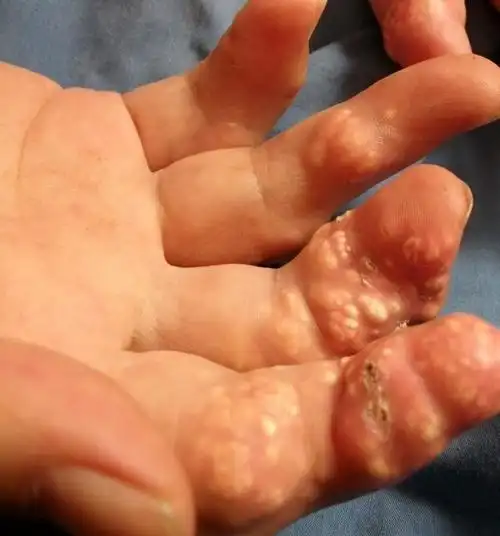 长满痛风石的手指图片