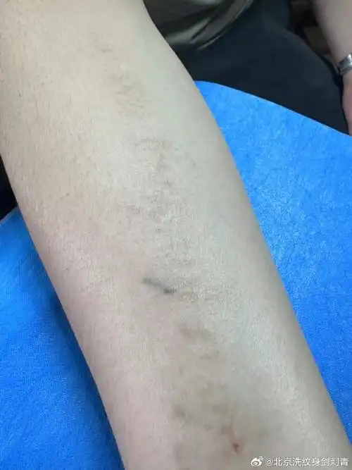 洗纹身不留疤##纹身恢复后##洗纹身不留疤##北京洗纹身##纹身##清洗