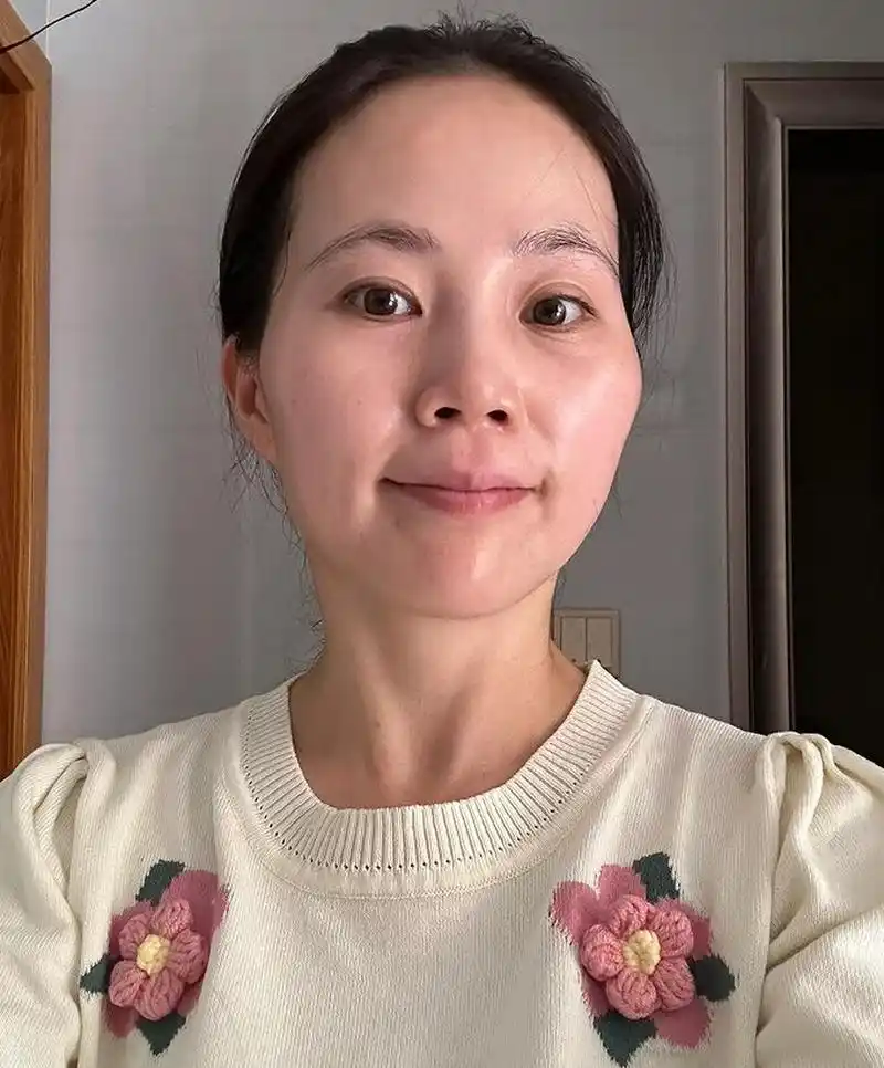 颧骨高克夫脸,我去做了微调,老公真的转运了  之前我也不相信这些