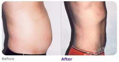 腹部吸脂对比照