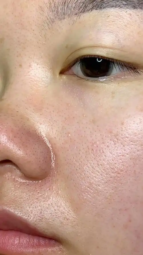 毛孔粗大 黑头粉刺多 满面油光 一招解救