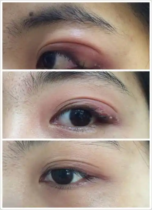 背部挑治治疗麦粒肿