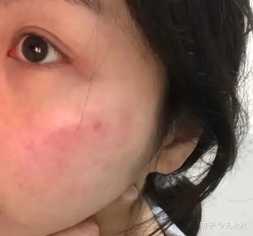 皮肤屏障受损怎样修复? - 知乎