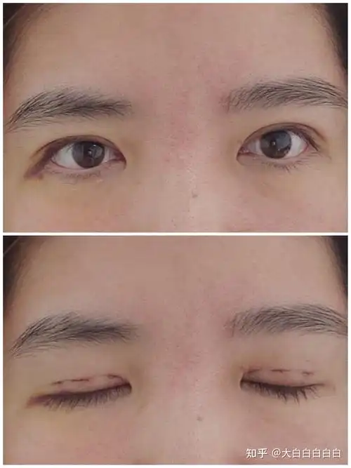 三点定位重睑术恢复过程记录