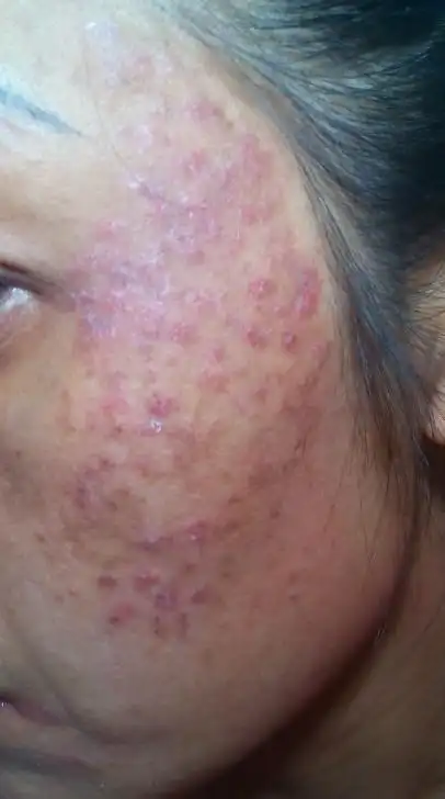 谁能告诉我脸上出现这是什么皮肤病呀