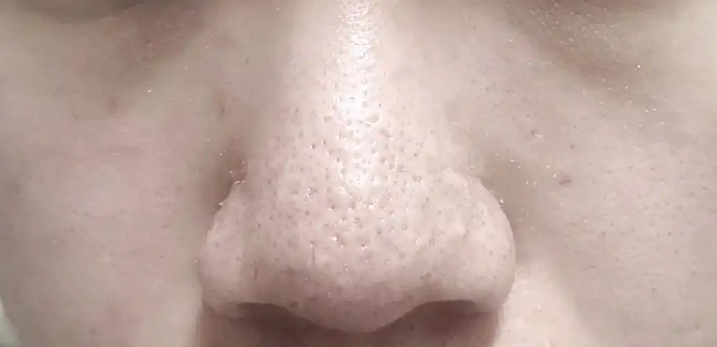 像鼻子和皮肤这样的毛孔粗大黑头多的做_新氧-专业医美服务平台